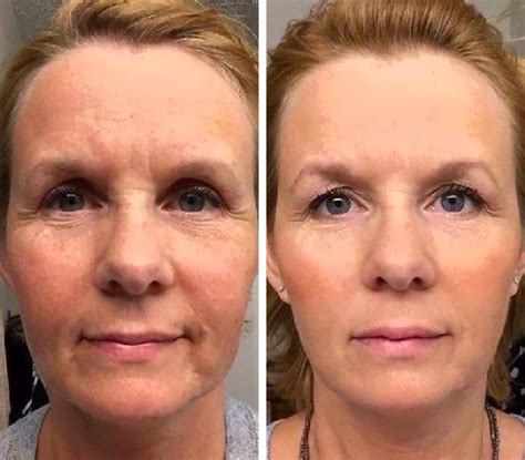 jade roller before and after|I Used a Jade Roller for 30 Days and It Changed My .